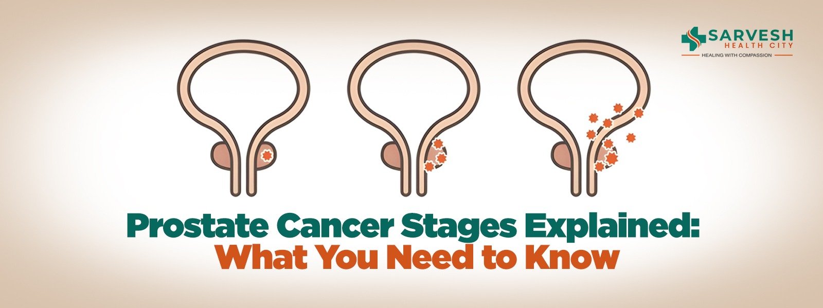 prostate-cancer-stages-explained-what-you-need-to-know
