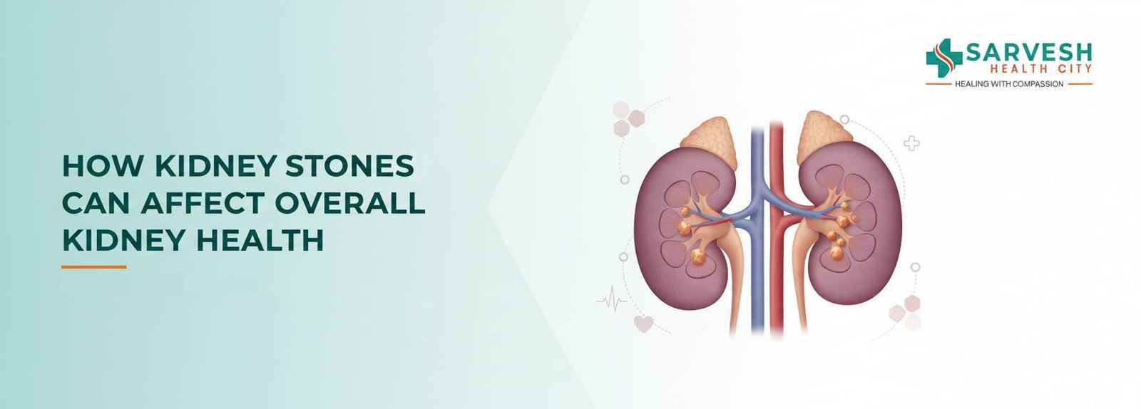 how-kidney-stones-can-affect-overall-kidney-health